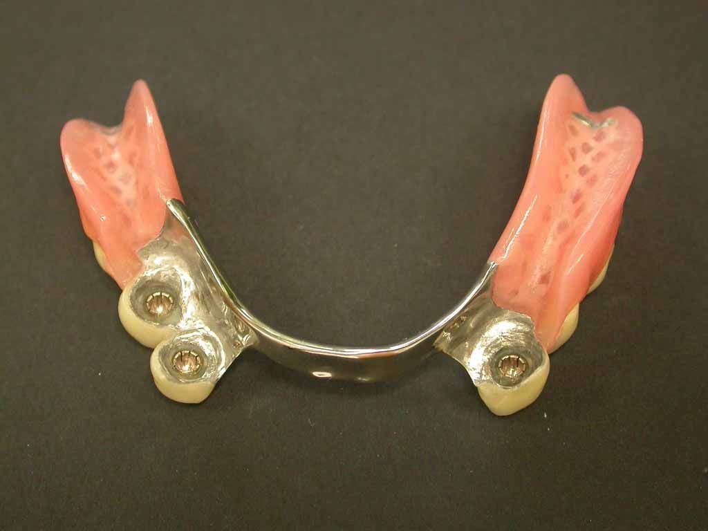 Unterkiefer Druckknopfprothese - Daniel Wirz Zahnprothetik - Zürich