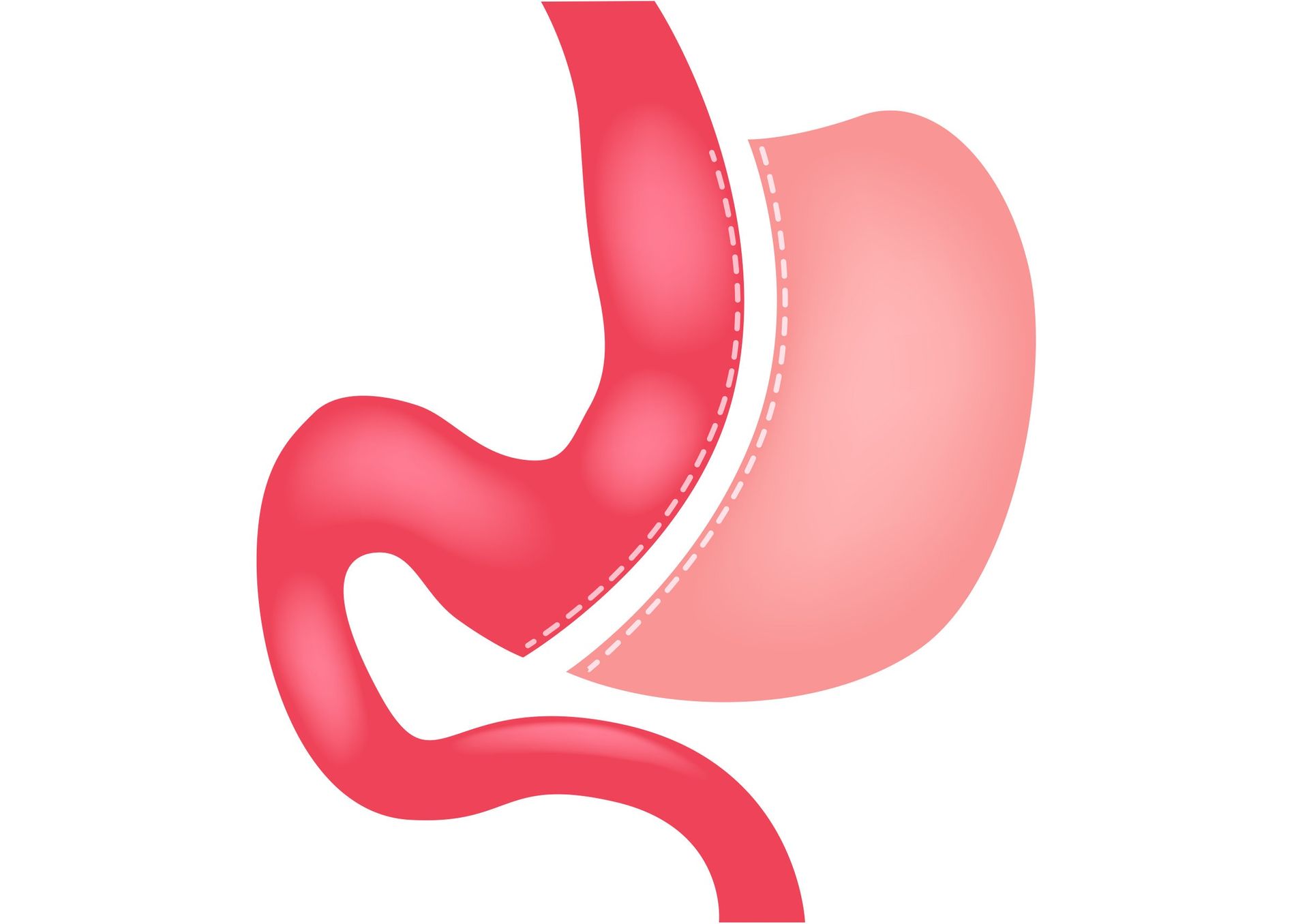 Diagrama de un estómago después de una cirugía de manga gástrica, que muestra un estómago más pequeño e intestinos redirigidos.