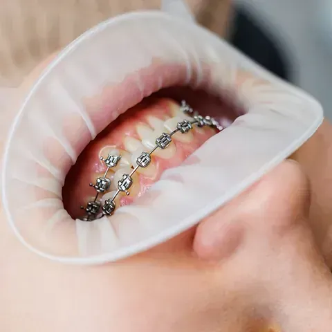 Boca con aparatos ortopédicos abiertos mediante un retractor de mejillas, mostrando los dientes y el material de ortodoncia.