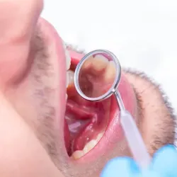 Boca con espejo dental, mostrando una muela, encías y el interior de la mejilla.