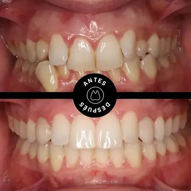 Arriba: Dientes torcidos. Abajo: Dientes rectos y alineados. Ortodoncia antes y después.