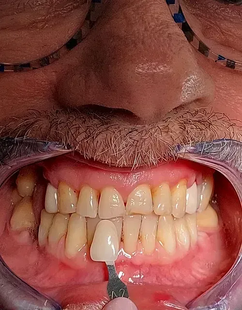 Una persona se compara el color de sus dientes. Se coloca una guía de colores frente a sus dientes para comparar.