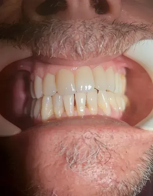 Primer plano de la boca de un hombre, mostrando dientes y encías. Los dientes son de color blanco amarillento y las encías son rosadas.
