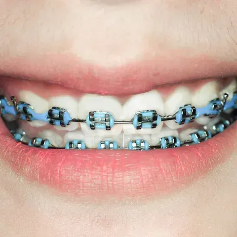 Primer plano de la boca sonriente de una persona con aparatos dentales de color azul claro en los dientes.
