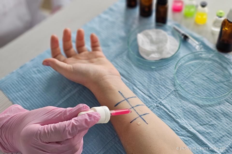 Der Arm einer Person mit markiertem Raster wird auf Allergien getestet. Eine behandschuhte Hand trägt Flüssigkeit mithilfe einer Pipette auf.