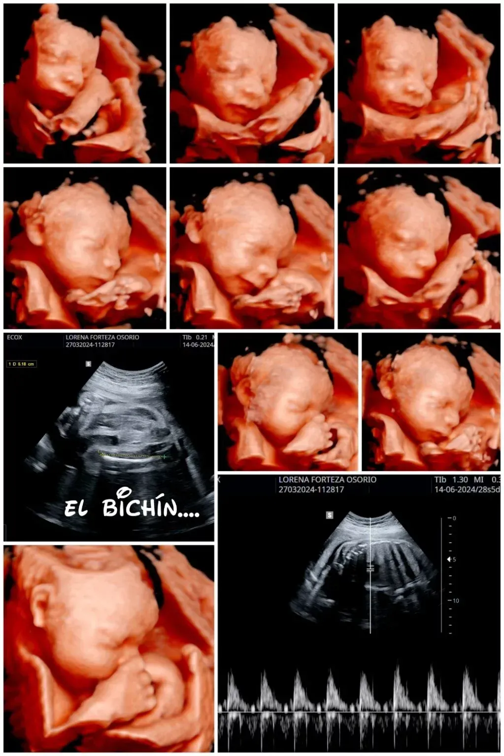 Collage de imágenes de ultrasonido fetal en 3D y una ecografía en blanco y negro con latido cardíaco.