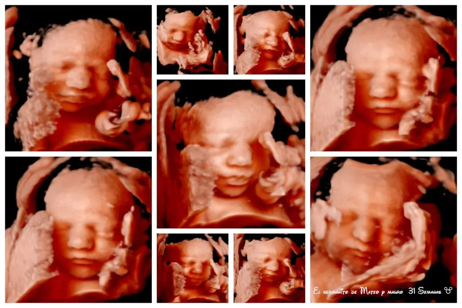 Collage de ultrasonido 3D del rostro de un feto desde múltiples ángulos dentro del útero.