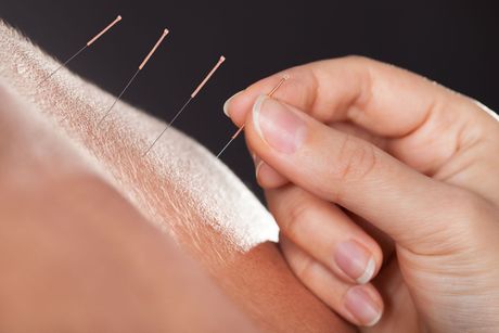Una persona está recibiendo acupuntura en su brazo.