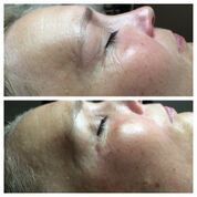 vorher-nacher-jetpeel-Facella