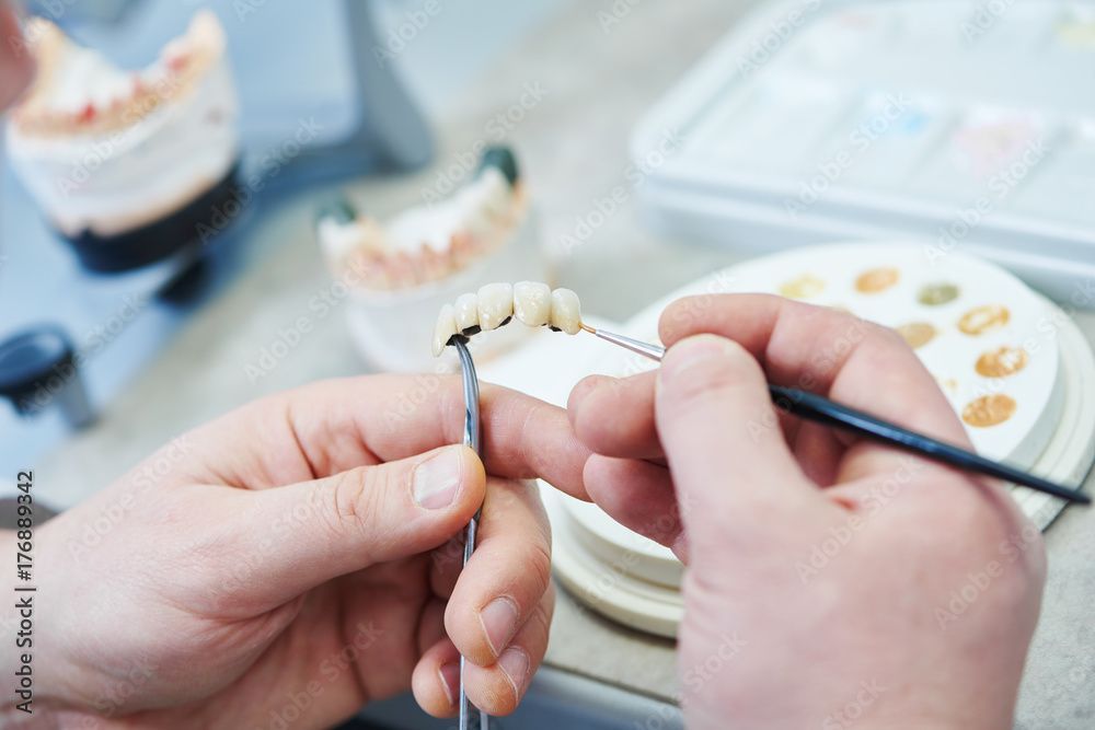 Hände bemalen in einem Dentallabor mit einem kleinen Pinsel eine Zahnbrücke.