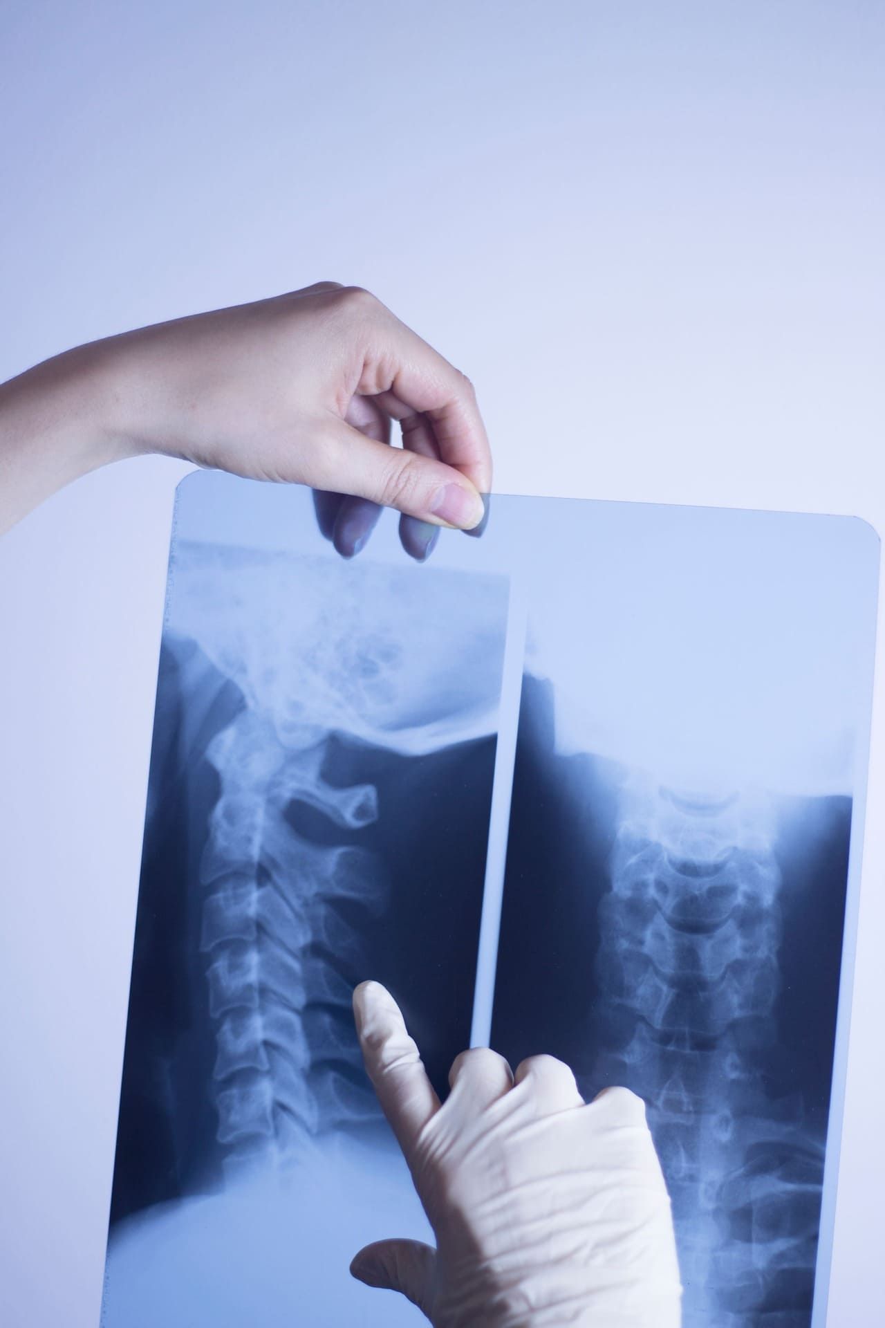 Manos sosteniendo dos radiografías de cuello a contraluz.