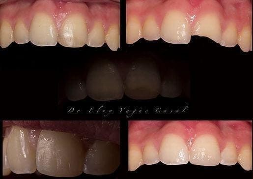 Collage de primeros planos de dientes antes y después del blanqueamiento, que muestra los dientes frontales y las encías más brillantes.