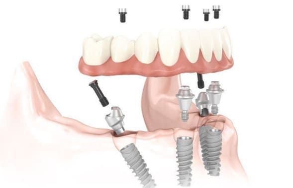 Ilustración 3D de un implante dental que muestra dientes protésicos, encía y postes metálicos en una sección transversal de la mandíbula.