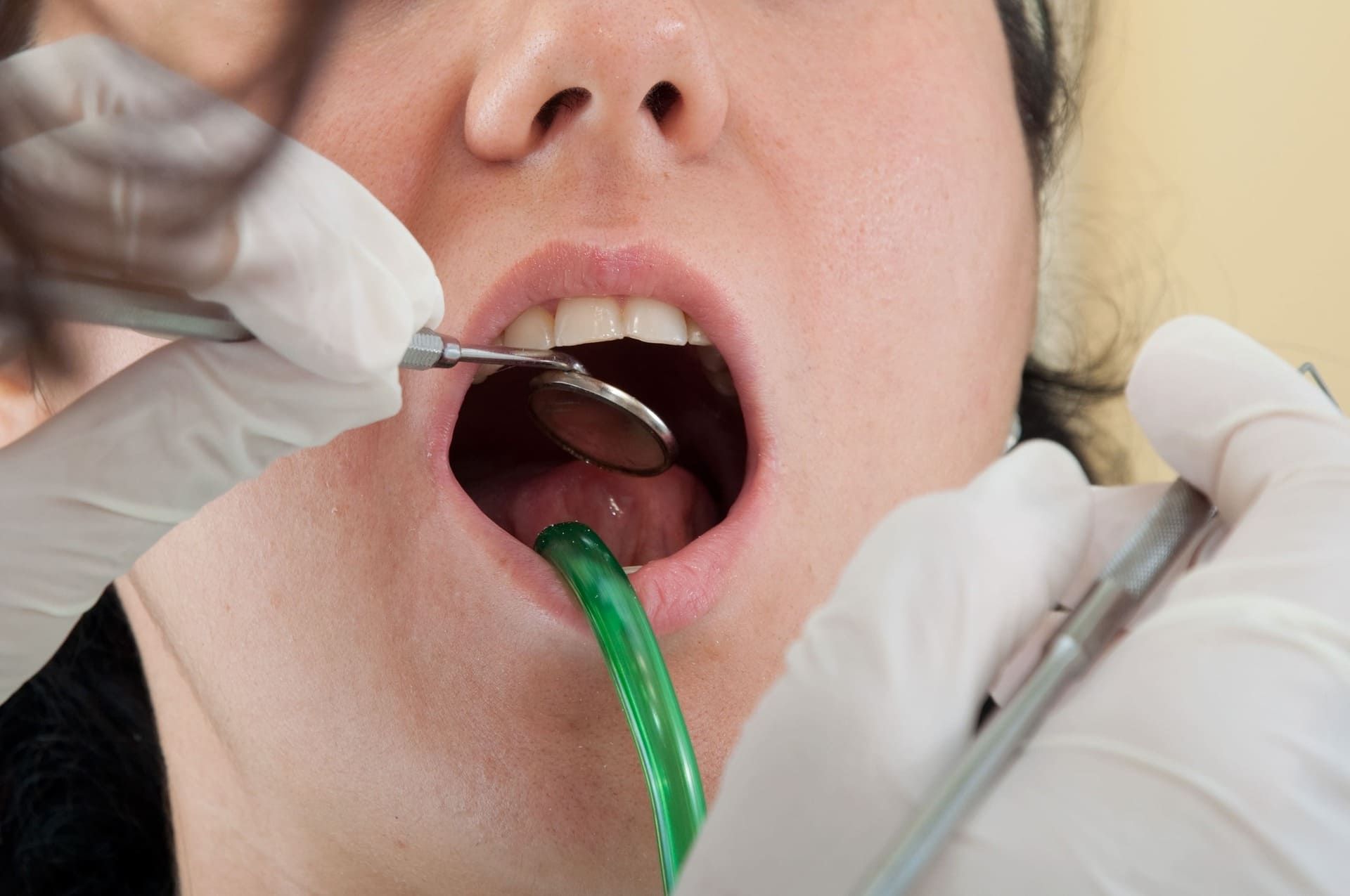 Dentista trabajando dentro de la boca abierta de un paciente con instrumentos dentales y un tubo de succión verde.