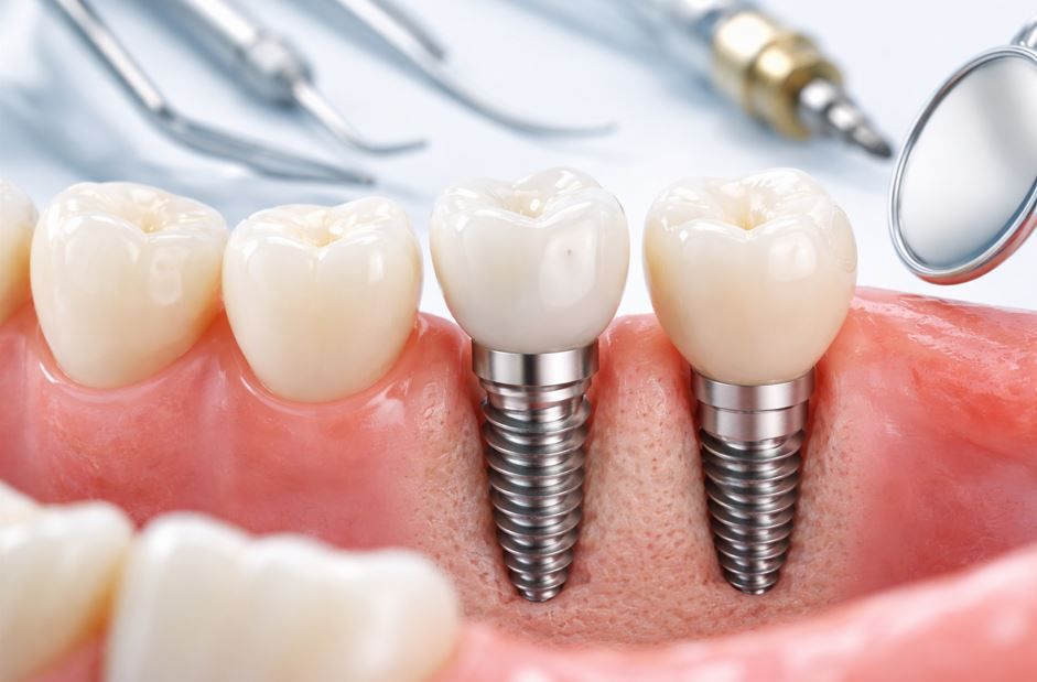 Primer plano de implantes dentales con coronas blancas en encías rosadas, vistos con instrumentos dentales cerca.