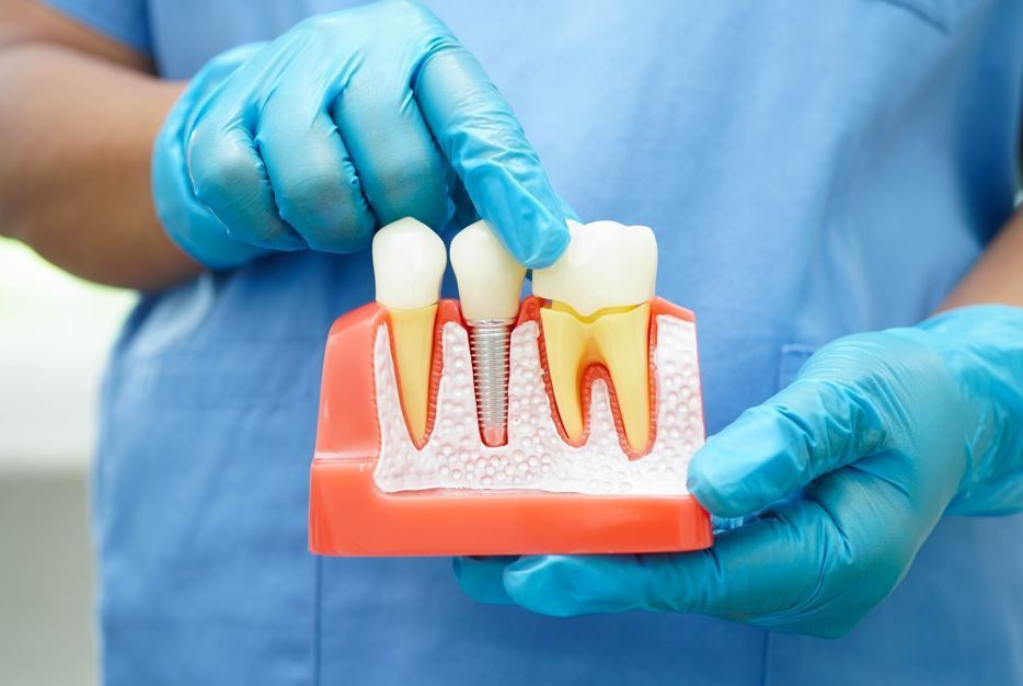 Manos enguantadas sosteniendo un modelo dental con dientes y encías, mostrando un diagrama de un procedimiento de implante.