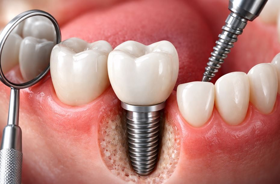 Implante dental en las encías junto a un espejo y un taladro dental.