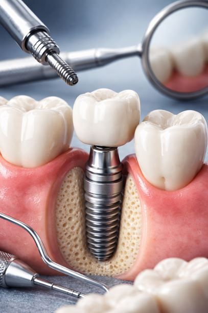 Implante dental colocado en las encías junto a los dientes blancos, con instrumental quirúrgico visible.