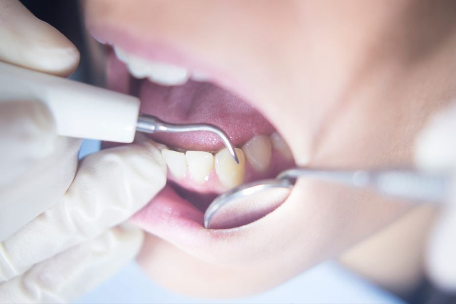 Un dentista limpia los dientes con instrumentos dentales en la boca abierta del paciente.