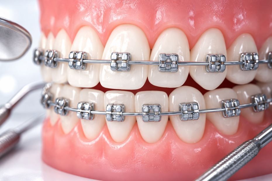 Primer plano de dientes con aparatos de ortodoncia 