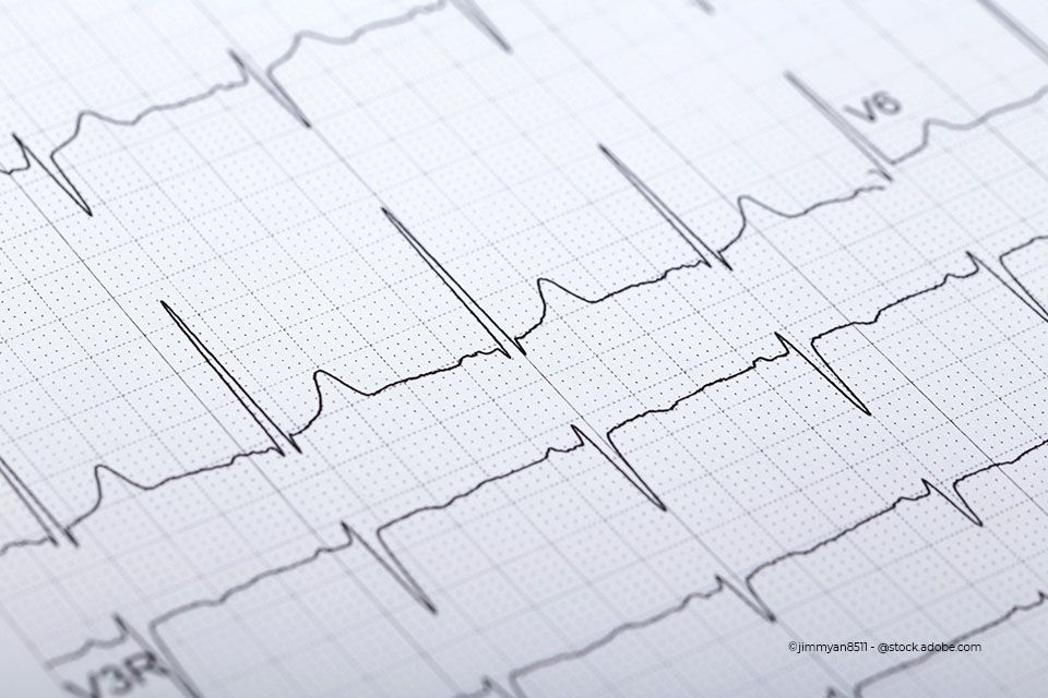 EKG vom Herz