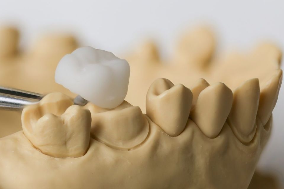 Cerec Modell - Zahnarztpraxis Cramm Muttenz
