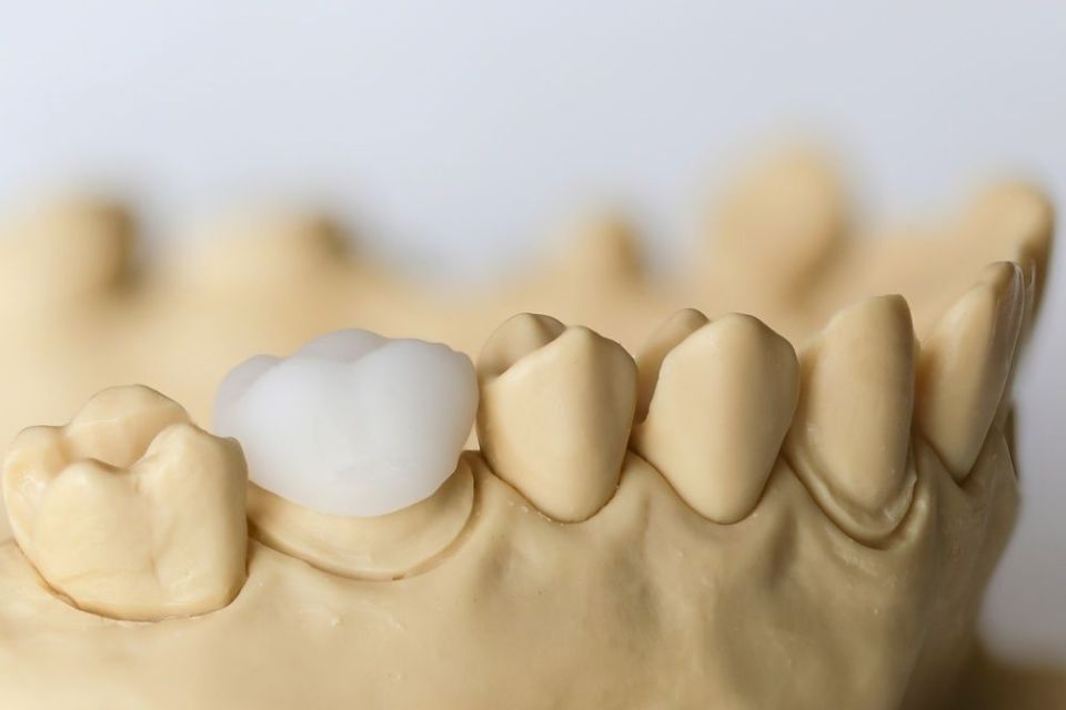 Cerec Modell - Zahnarztpraxis Cramm Muttenz