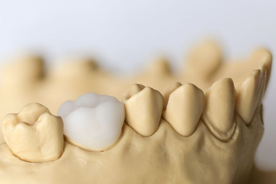 Cerec Modell - Zahnarztpraxis Cramm Muttenz
