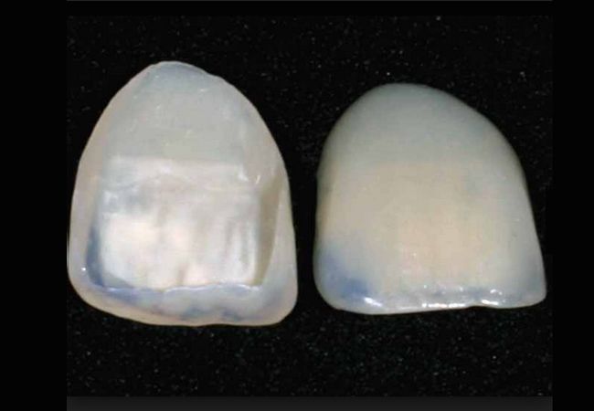 Ventajas de las carillas de porcelana