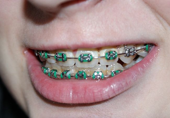 Brackets: invierte en tú sonrisa