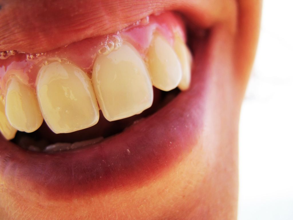 Las ventajas de cada ortodoncia