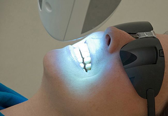 Métodos de blanqueamiento dental