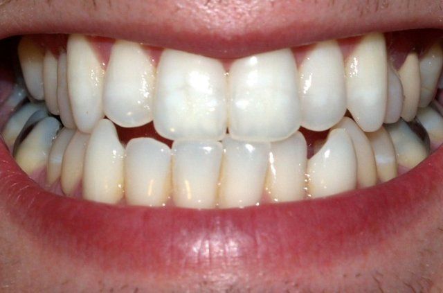 Las consecuencias del bruxismo dental