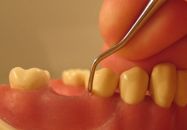 Enfermedades periodontales