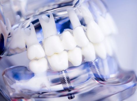 Un primer plano de un modelo de dientes con tornillos en ellos.