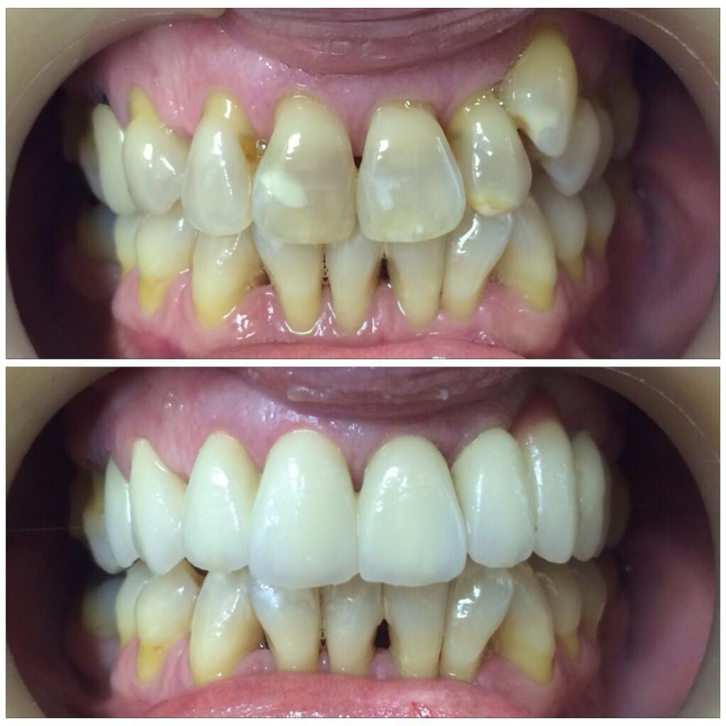 Una fotografía de antes y después de los dientes de una persona.