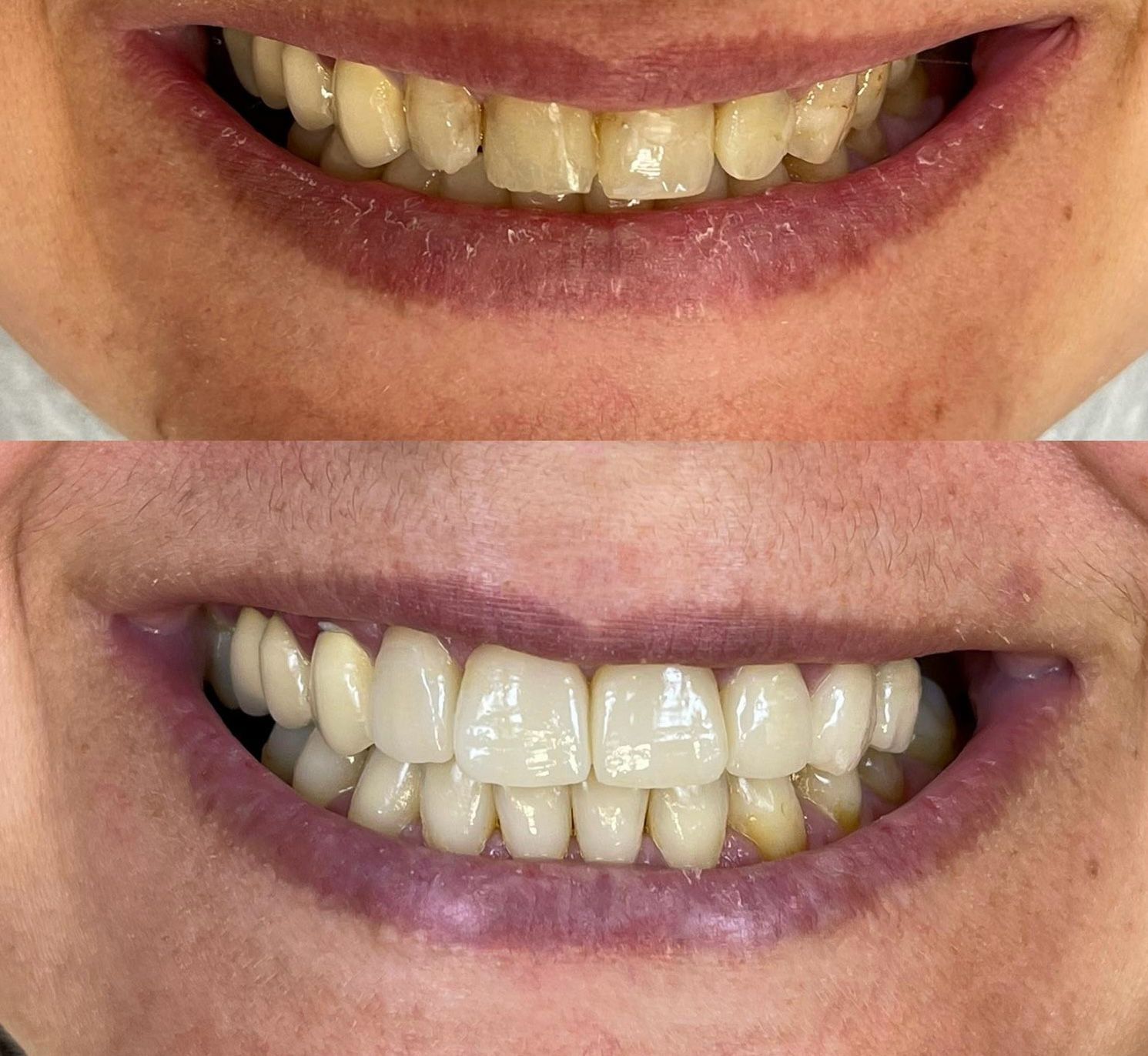 Una fotografía de antes y después de los dientes de una mujer.
