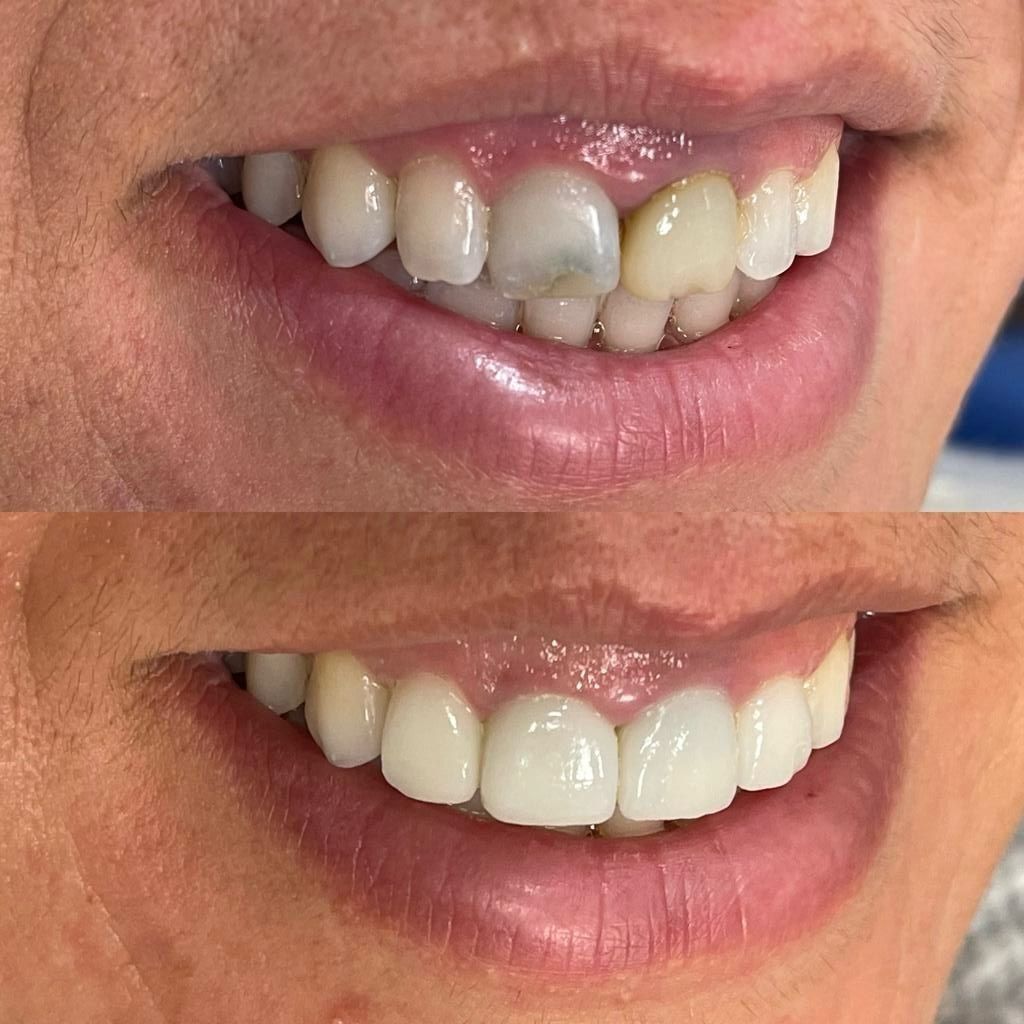 Una fotografía de antes y después de los dientes de una mujer.