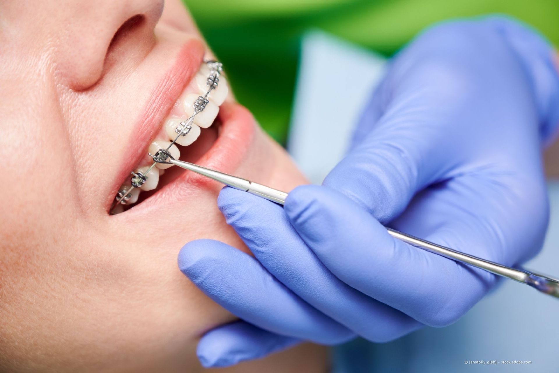 Person bekommt Brackets auf die Zähne gesetzt