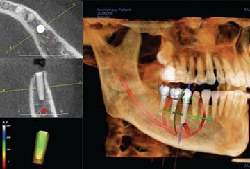 Una imagen generada por computadora de los dientes y el cráneo de una persona.