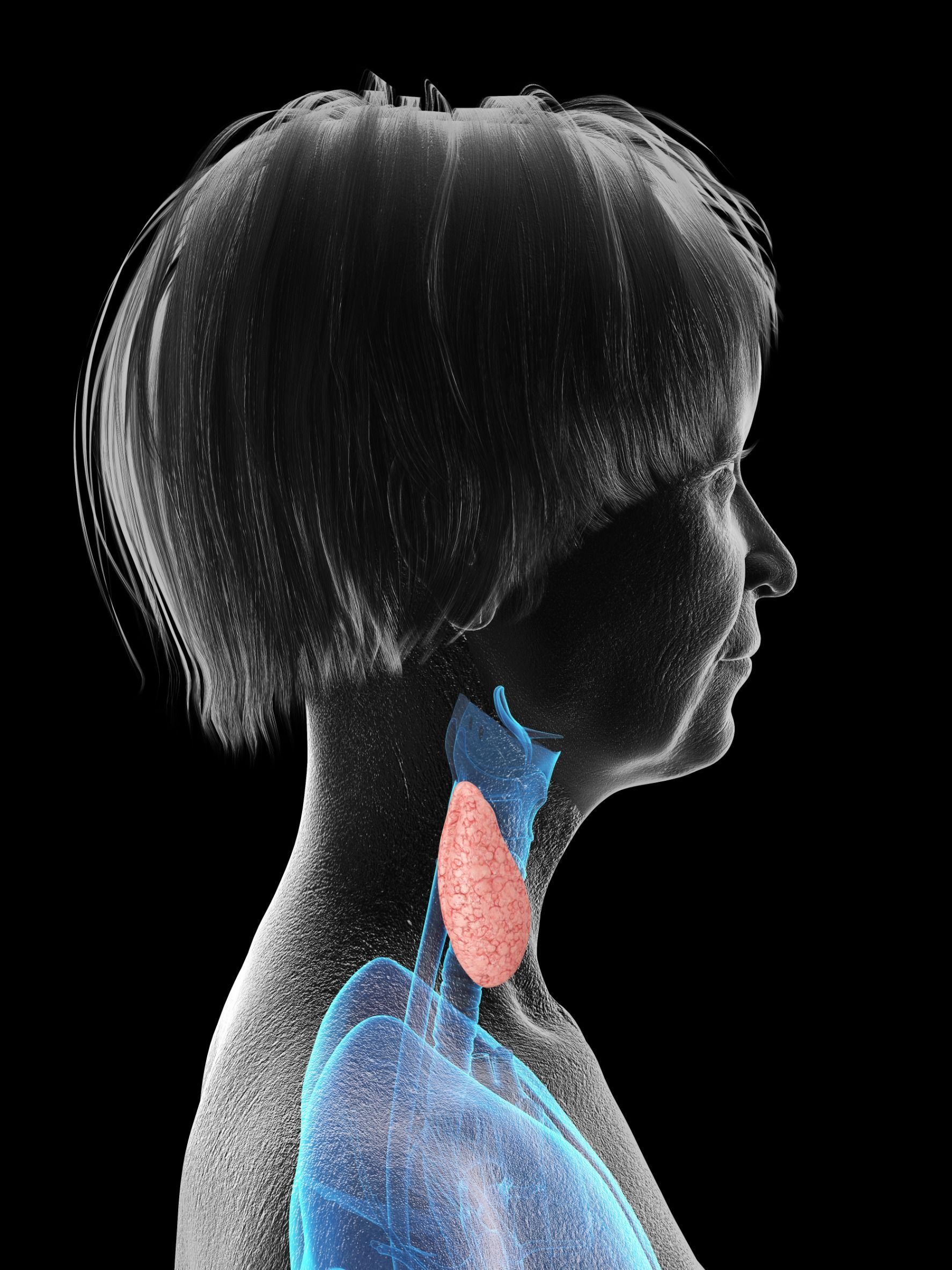 Una imagen en blanco y negro del cuello y el hombro de una mujer con la glándula tiroides resaltada.