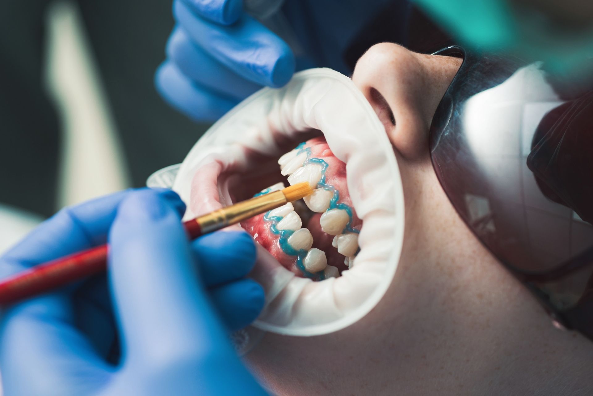 Un dentista está blanqueando los dientes de un paciente con un cepillo.