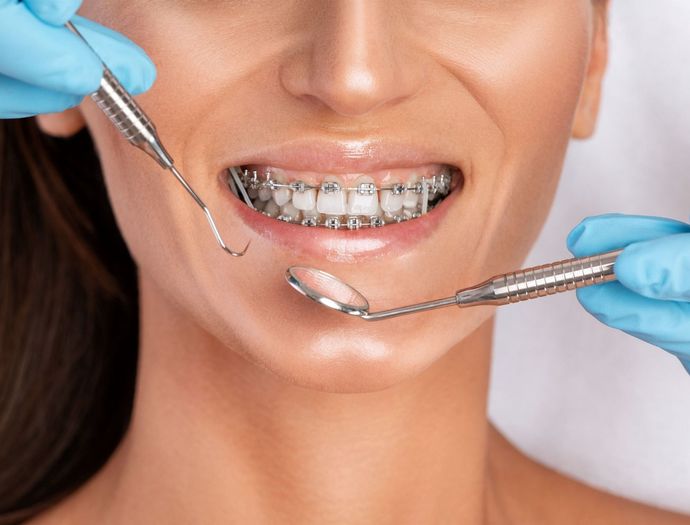 Una mujer con aparatos ortopédicos se hace examinar los dientes por un dentista.