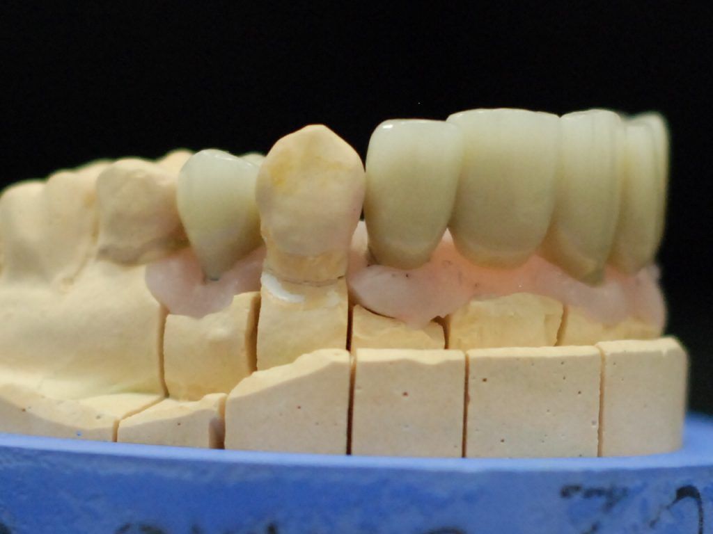 Gros plan sur une prothèse adjointe