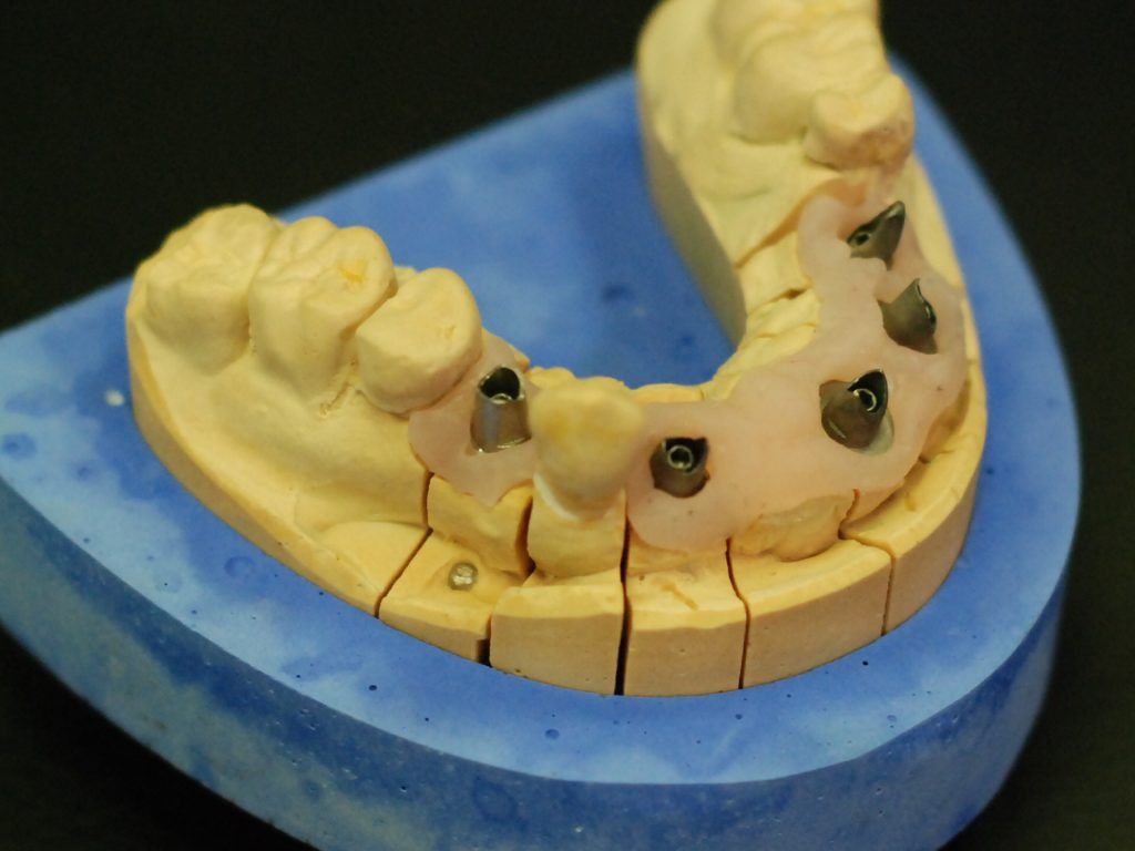 Cinq implants avant la pose d'une prothèse sur une mâchoire inférieure