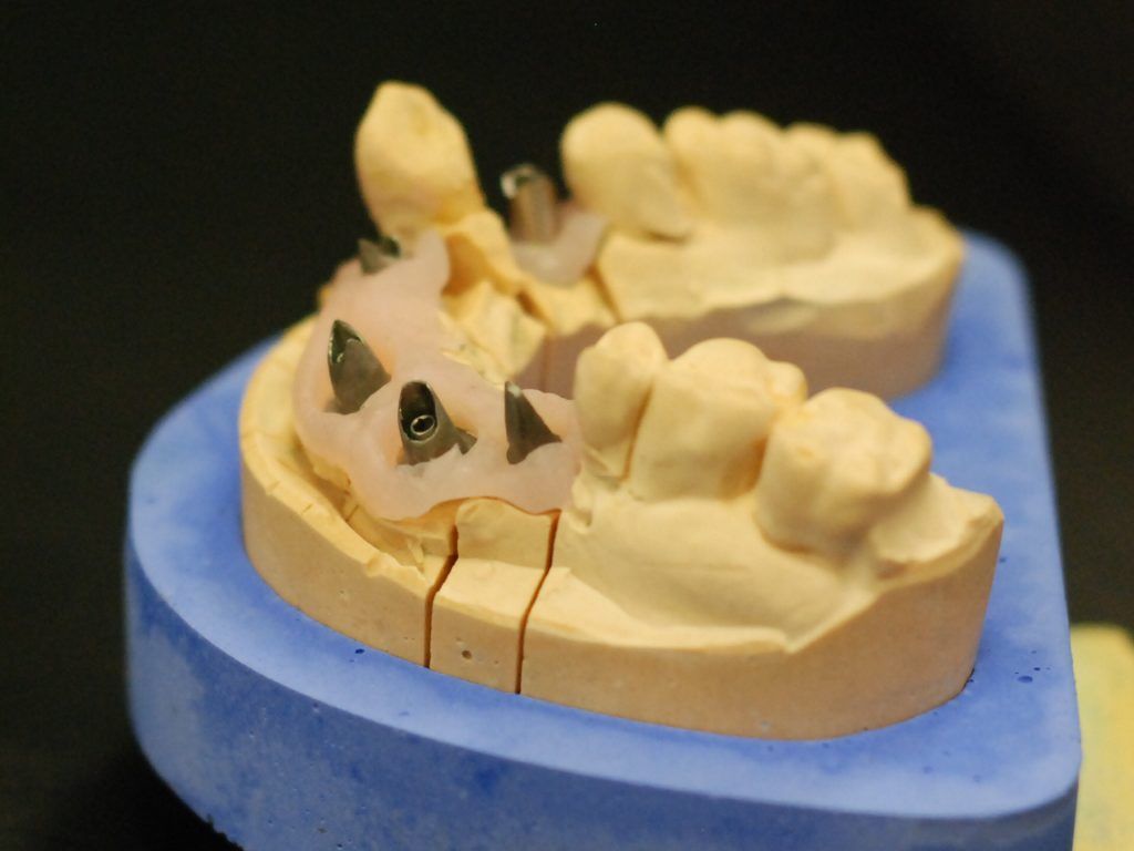 Cinq implants avant la pose d'une prothèse sur une mâchoire inférieure vue latérale