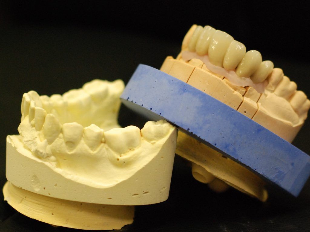 Prothèse conjointe pour une mâchoire inférieure