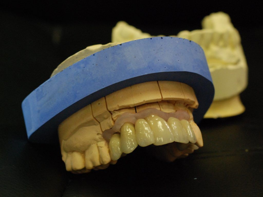 Prothèse conjointe sur un moule