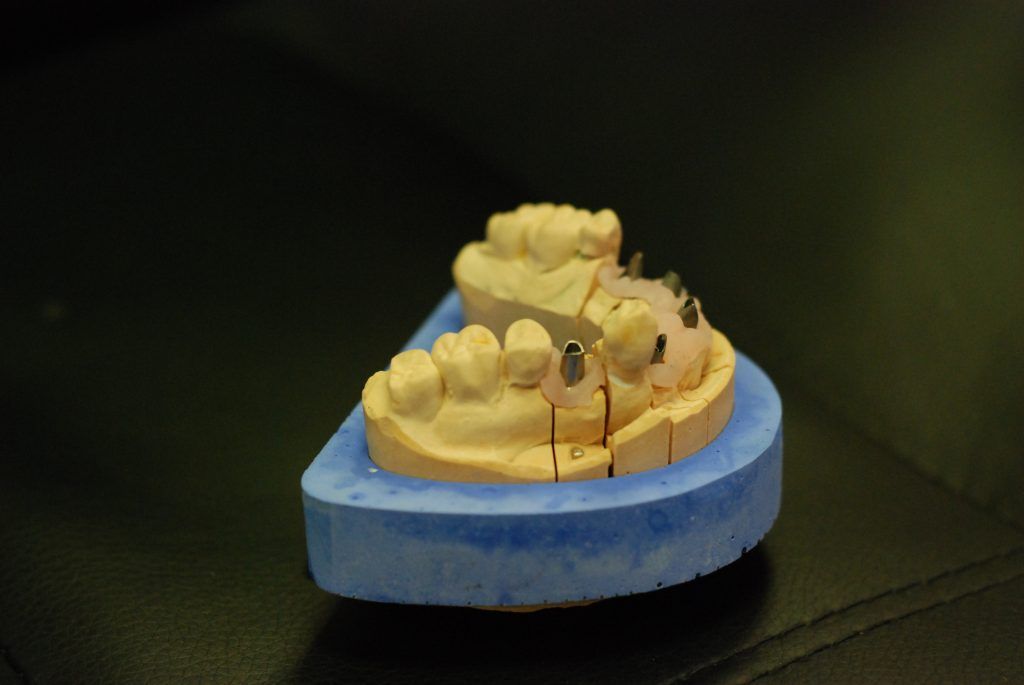 Implants en vue de la pose d'une prothèse