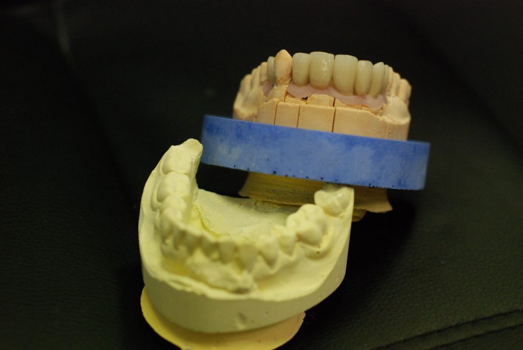 Prothèse conjointe de la mâchoire supérieure de face